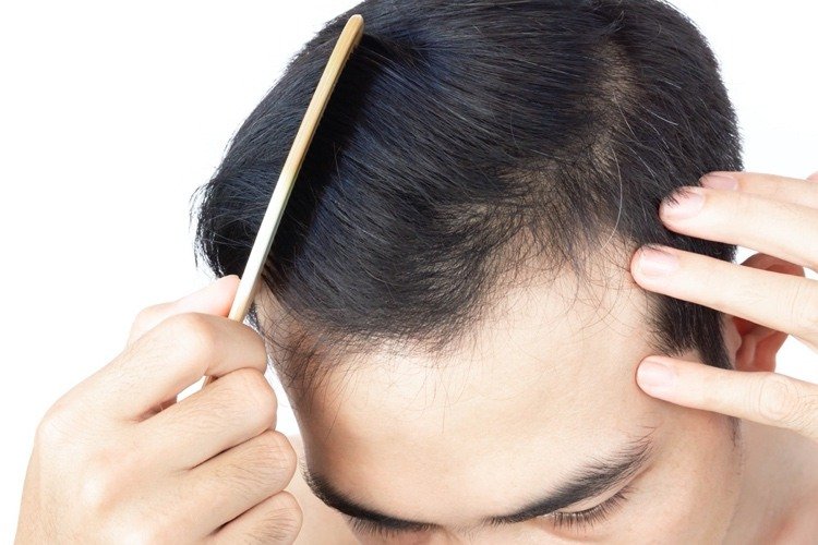 مع زراعة الشعر Neo Fue ، يكون معدل نمو الشعر المزروع أعلى