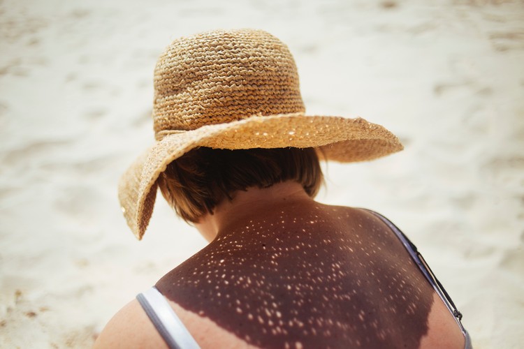 علاج الصدفية الصيفية للحماية من أشعة الشمس